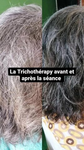 Chimiothérapie, la Trichothérapy est efficace avant et après 